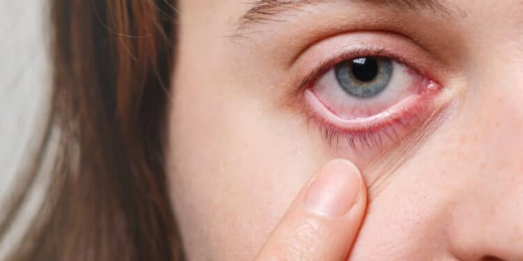 Falta de cuidados no uso de lentes de contato aumenta o risco de complicações oculares