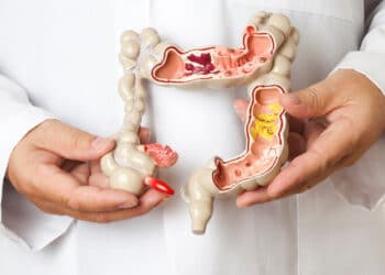 Câncer colorretal: prevenção e detecção precoce são fundamentais, alerta oncologista