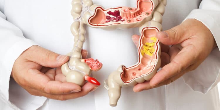 Câncer colorretal: prevenção e detecção precoce são fundamentais, alerta oncologista