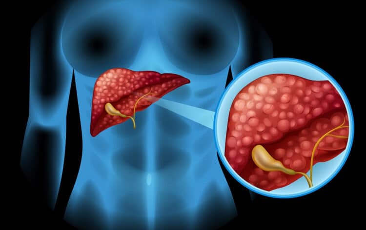 Hepatites virais: medidas preventivas e diagnóstico precoce podem salvar vidas