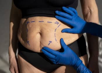Diástase abdominal: o que é, sintomas, prevenção e tratamento