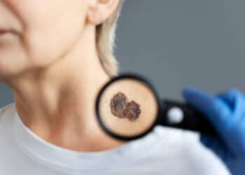 Melanoma cutâneo: entenda os fatores de risco para o tipo mais perigoso de câncer de pele