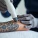 Tatuagem é passado: entenda como funciona a remoção a laser e suas contraindicações