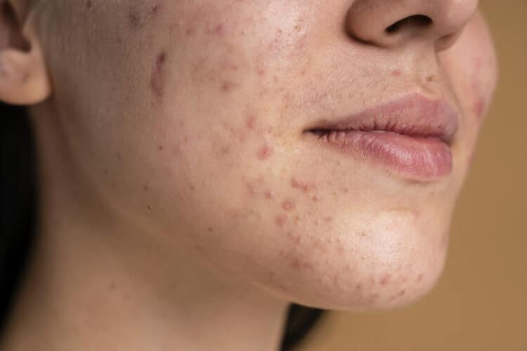 Dermatologia e autoestima: o impacto emocional de doenças de pele
