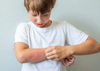 Picada de abelha em crianças: quando se preocupar?