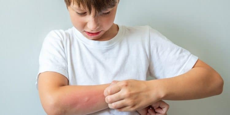 Picada de abelha em crianças: quando se preocupar?