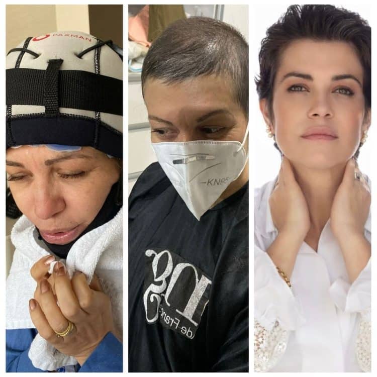 Médica conta que a perda do cabelo durante o tratamento de câncer de mama mudou sua percepção da própria beleza